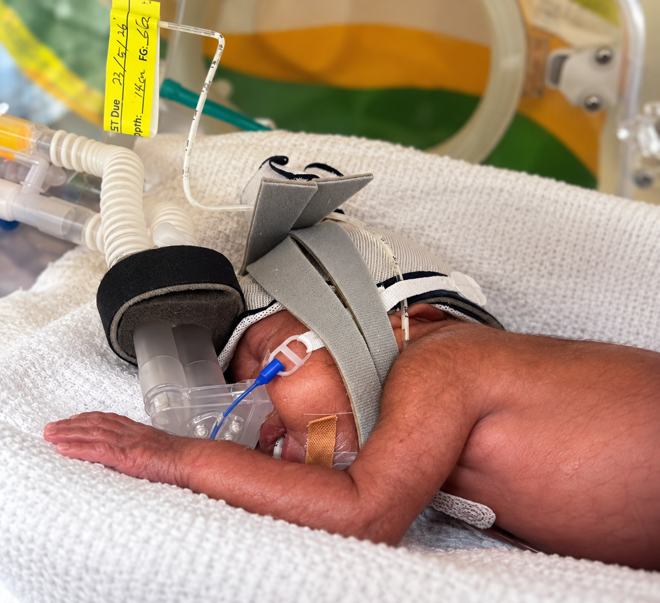 À seulement 351 grammes à la naissance, cette petite fille née à 21 semaines a survécu — média 2