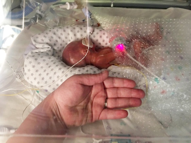 Né à seulement 22 semaines, Oliver s’accroche à la vie malgré des chances infimes de survie