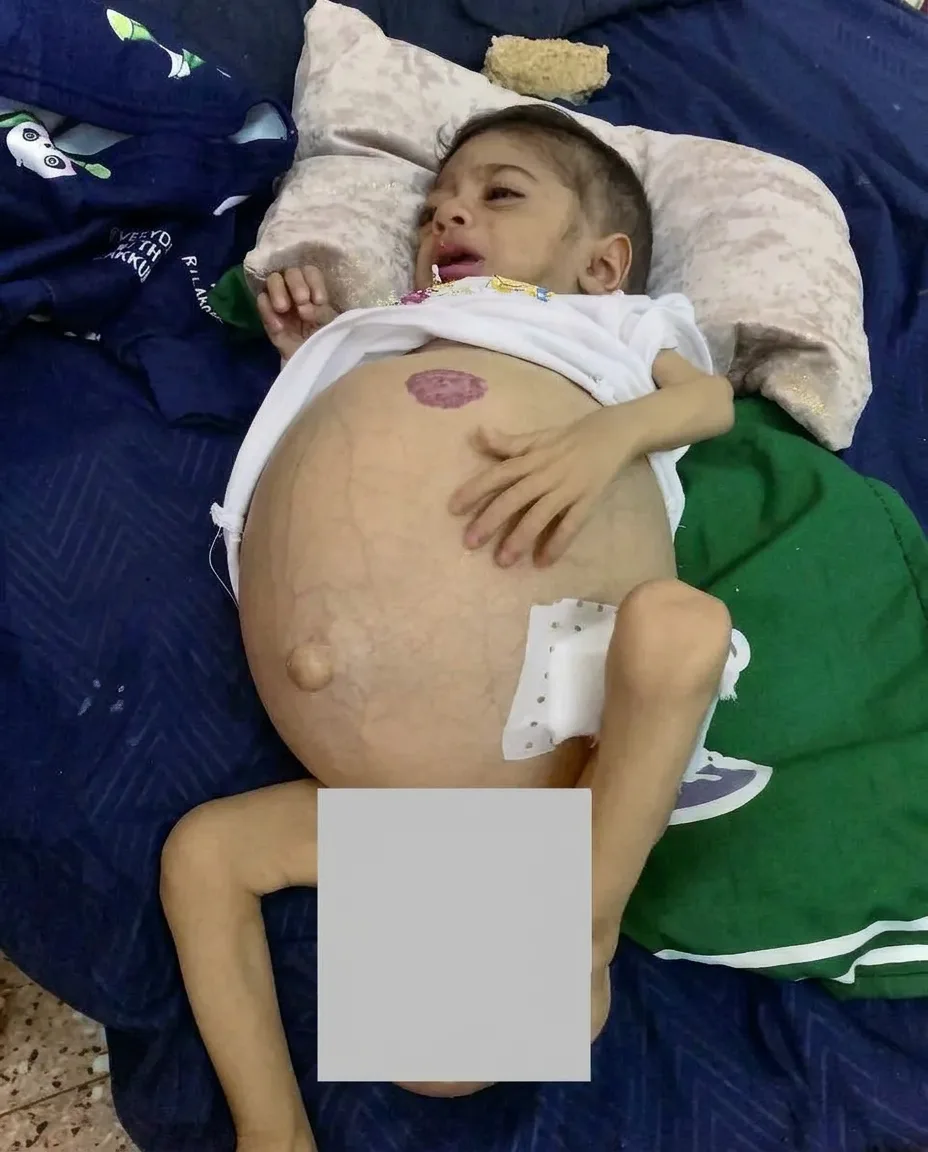 Noticias de Adem: un trasplante hepático exitoso gracias a vuestro apoyo