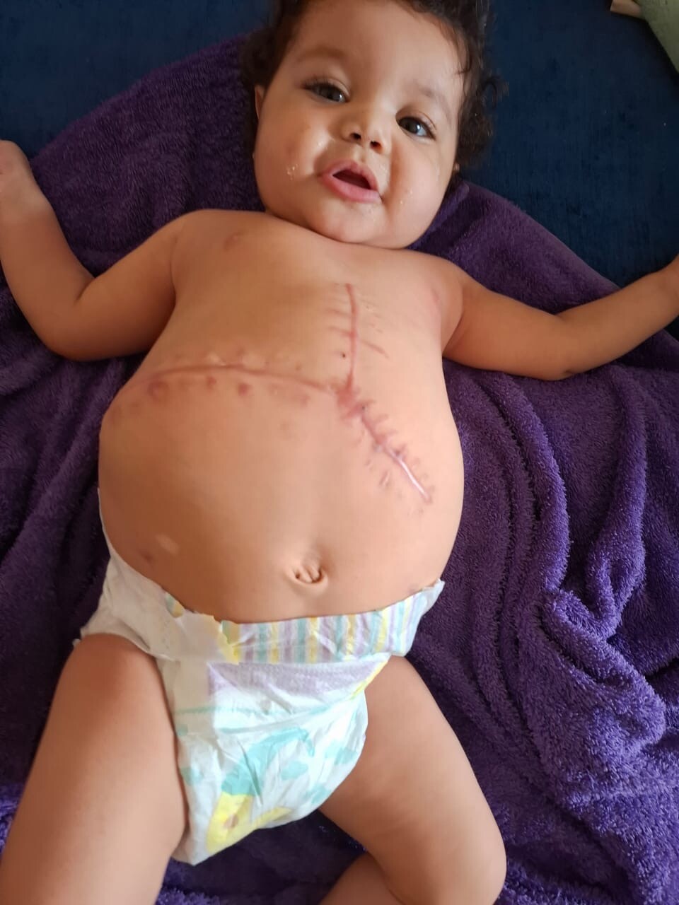Hidaya después de su trasplante de hígado